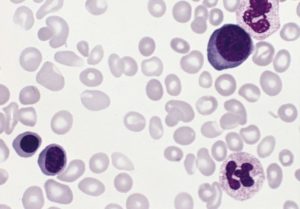 polycythemia vera blood smear