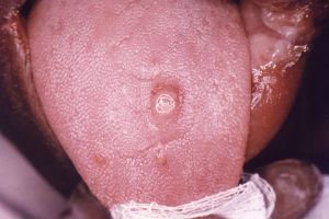primary stage syphilis sore chancre on the surface of a tongue