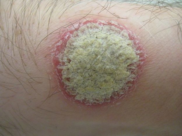 scalp psoriasis child treatment