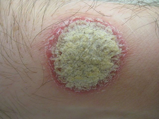 psoriasis child symptoms