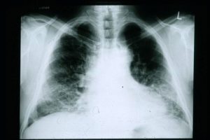 A chest radiograph of a patient with Idiopathic Pulmonary Fibrosis (IPF).