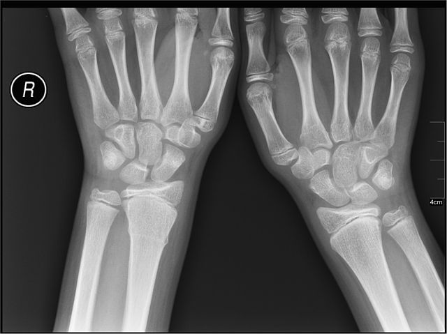 Common Pediatric Fractures Classification And Radiology