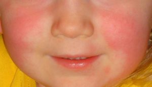 Scarlet fever rash