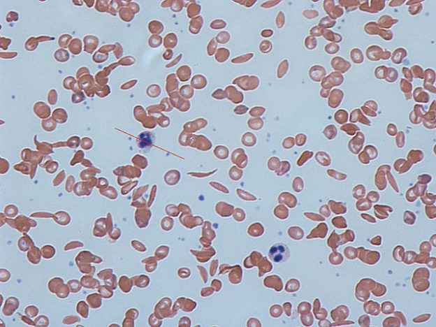 Normocytic Anemia Sickle Cell Anemia Sickle Cell Disease Lecturio