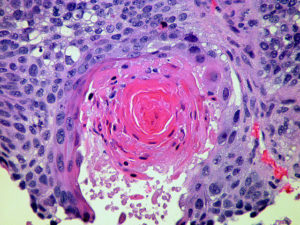 squamous cell carcinoma