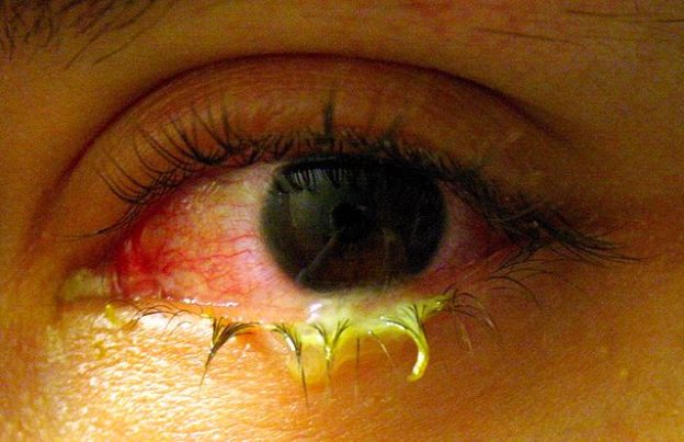 Swollen eye with conjunctivitis