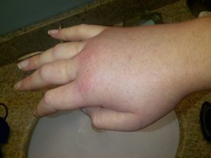 Swollen hand during a hereditary angioedema attack