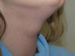 thyroglossal cyst