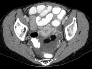 CT of an ovarian teratoma