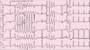 Torsades de pointes