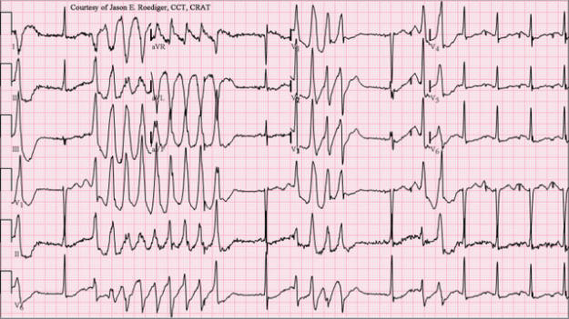 Torsades de Pointes