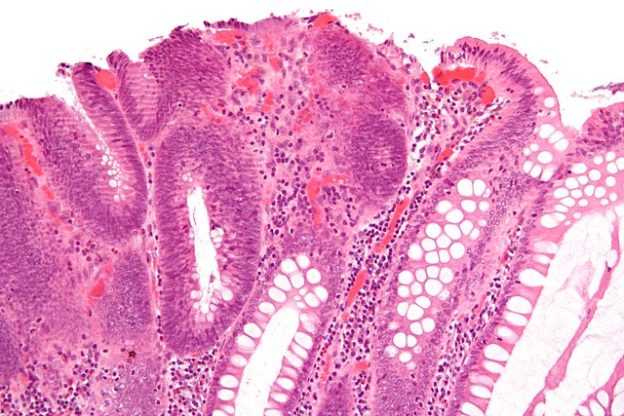 fragments of tubular adenoma and hyperplastic polyp