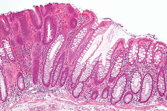 Colorectal Cancer (CRC) in Women — Screening and Prevalence