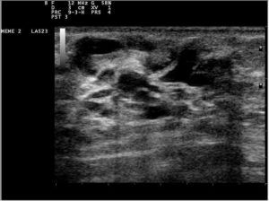 Ultrasound image of intraductal papilloma