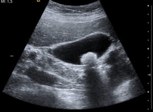 ultrasound image of gallbladder stone gallstone