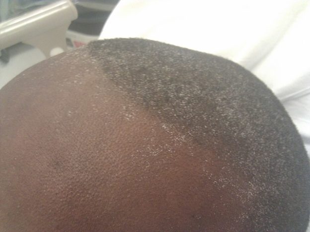 Uremic frost