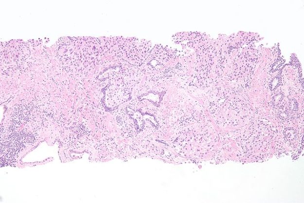urethral-urothelial-cell-carcinoma