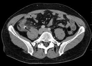 ct scan showing a fecalith which has caused appendicitis