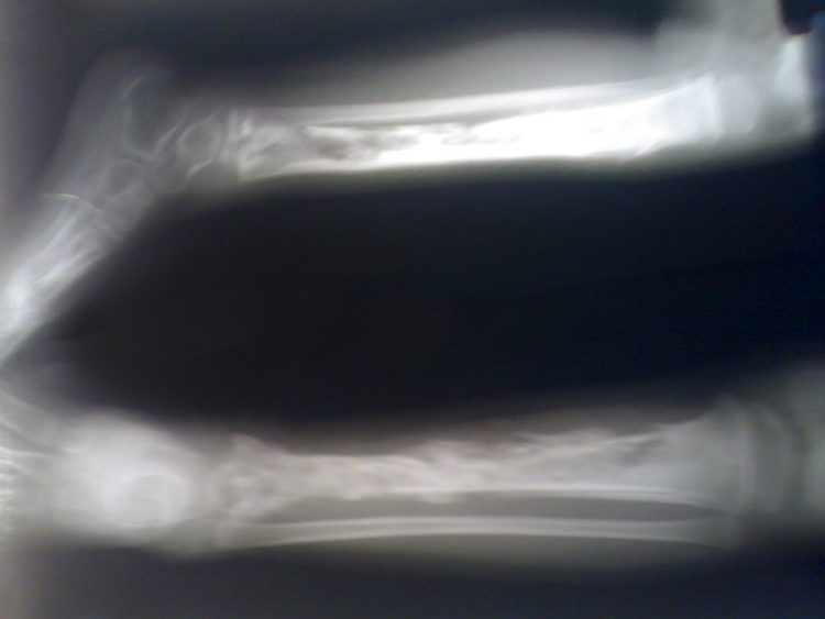 Osteomyelitis in Children — Diagnosis and Treatment | Medical Library
