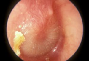 Acute Otitis Media Stage of Resolution