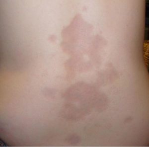 MercMorphea