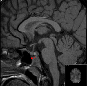 Normal pituitary gland on MRI (T1 sagittal without contrast enhancement). The arrow points at the posterior pituitary (intense signal), and the arrowhead at the anterior pituitary.