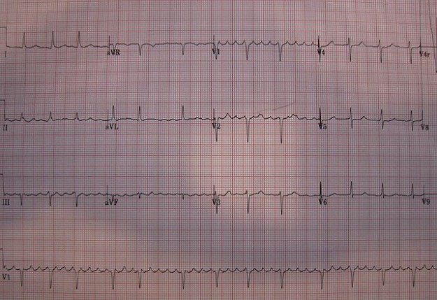 p atrial flutter icd 10