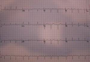 A 12 lead ECG showing atrial flutter A 12 lead ECG showing atrial flutter
