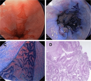 Endoscopy Endoscopy
