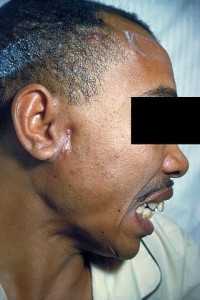 A patient with actinomycosis