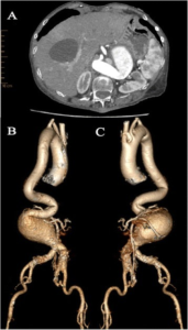 AAA-preoperative infrarenal aaa