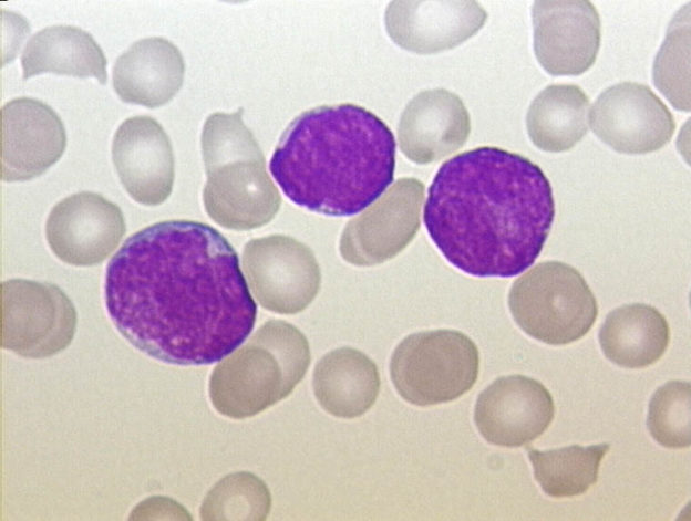 ALL Peripheral Blood