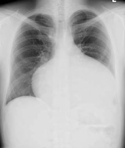 ASD-Chest-X-Ray