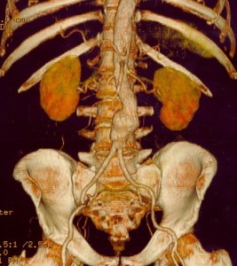Abdominal Aortic Aneurysm in Computer Tomography Abdominal Aortic Aneurysm in Computer Tomography