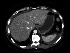 Abdominal CT with Contrast