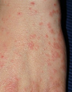 Acarodermatitis Hand Acarodermatitis Hand