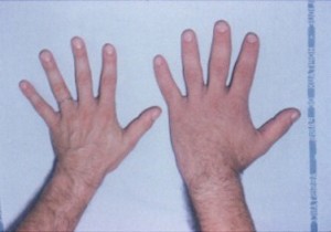 Acromegaly Acromegaly