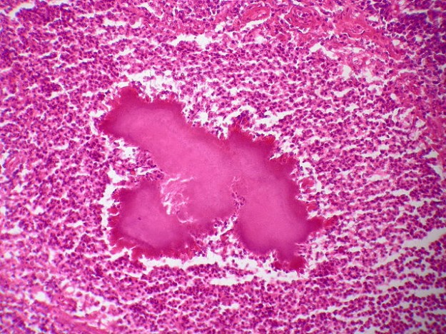 Actinomycosis