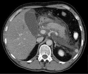 Acute pancreatitis