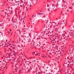 Acute pyelonephritisry Acute pyelonephritisry
