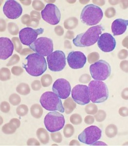 Acute_leukemia-ALL