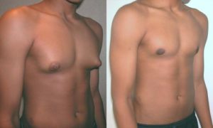 adolescent with gynecomastia