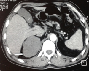 Adrenal-ganglioneuroma-CT