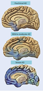 alzheimers disease progression of brain degeneration