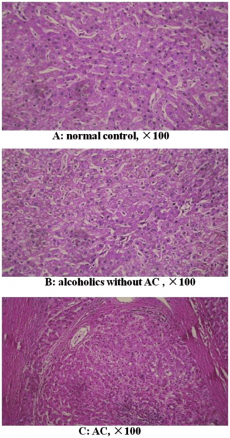 Analysis of mitochondrial transcription factor A SNPs in alcoholic cirrhosis Analysis of mitochondrial transcription factor A SNPs in alcoholic cirrhosis