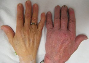 Anemia Anemia