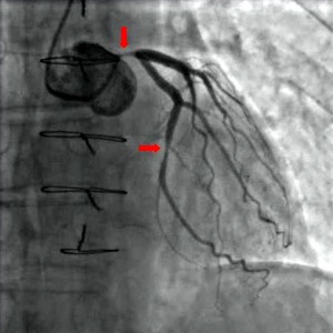 Angiography-coronary-stenosis
