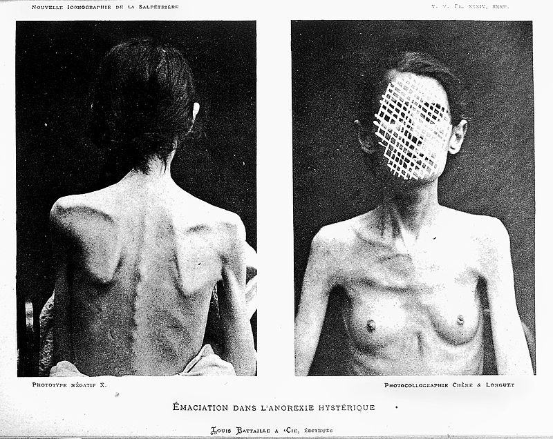 Anorexic emaciation in a hysteric General Collections Keywords
