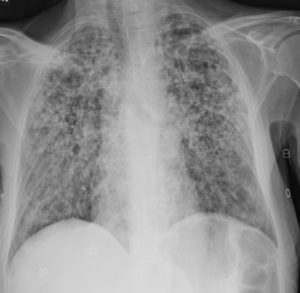 Anteroposterior chest radiograph showing diffuse bilateral interstitial and airspace opacities.