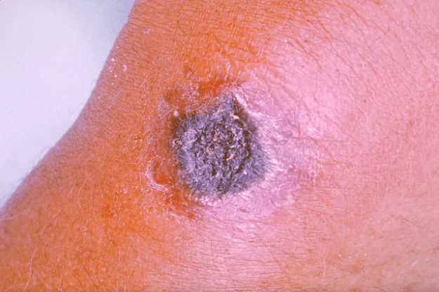 image of Anthrax
